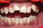 Figure 1  Clinical image showing fractured upper left and right central incisors.
