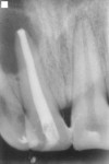 Figure 4  Calcium hydroxide dressing in upper right central incisor.
