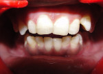 Figure 7  Composite restoration in upper right and left central incisors.