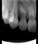 Figure 1  Pretreatment radiograph of tooth No. 7 at initial presentation (December 14, 2006).