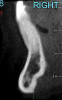 Fig 9. Healed implant site 12 weeks after surgery before re-entry.
