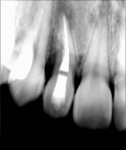 Figure 2  Postreatment radiograph of completed root canal therapy tooth No. 7 (December, 16, 2006).