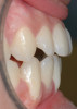 Fig 3. A clinical example of severe chronic endogenous biocorrosion effects from anorexia nervosa. This patient was diagnosed and treated by a physician for this condition, which left lingual maxillary enamel almost free of this hard tissue. (Photograph is courtesy of Ali Tunkiwala, MDS, used with his permission.)