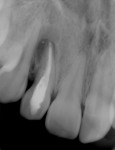Figure 3  Radiograph of tooth No. 7 upon presentation for pain (February 19, 2009).