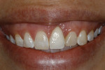 Figure 2  (Case 1) Pre-treatment smile. The etiology of the facial asymmetry is that the malposed implant was placed too far facially.