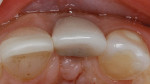 Figure 5  (Case 2) Incisal view, showing facial position of implant and crown.