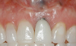 Figure 6  (Case 2) Recession caused by implant being placed facially outside osseous plate.