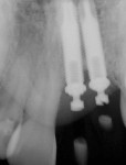 Figure 11  (Case 4) Radiograph showing close proximity of implants and the resulting bone loss.