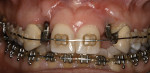 Figure 12  (Case 5) Pre-treatment photo showing missing papilla mesial to the canines and severe facial recession on the implants.
