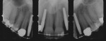 Figure 13  (Case 5) Pre-treatment radiographs showing implants placed in close proximity to right central incisor and left canine.