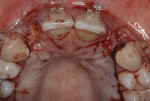 Figure 15  (Case 5) Occlusal view of the closed recipient sites and donor sites. The donor sites closed with primary closure. There was minimal discomfort from the closed donor sites.