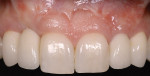 Figure 17  (Case 5) Final intraoral photograph of restorative treatment performed by author (Dr. Kinzer) showing excellent papilla development on the mesial of the left canine and moderate fill on the right side.