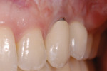 Figure 18  (Case 6) Patient disliked the metal margin showing on the facial of the No. 11 implant and desired improved tissue color; note the thinness of the facial tissues.
