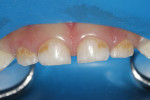 Figure 1 A 3-year-old presented with severe early childhood caries.