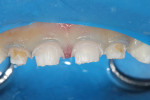 Figure 2 Orthodontic separators were placed to control hemorrhage.