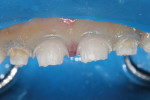 Figure 3 Supragingival circumference was reduced and decay excavated.
