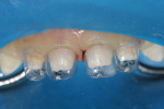 Figure 5 Strip crown forms were fitted simultaneously and vented incisally to allow for a void-free bulk fill.