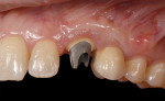 Figure 19  (Case 6) Increasing the thickness of the facial tissue surgically followed by changing the abutment materials significantly improved the overall esthetic appearance of the area.
