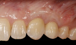 Figure 20  (Case 6) Increasing the thickness of the facial tissue surgically followed by changing the abutment materials significantly improved the overall esthetic appearance of the area.