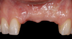 Figure 21  (Case 7) This patient lost his anterior teeth due to trauma and was left with significant loss of hard/soft tissue.