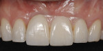 Figure 22  (Case 7) The definitive implant-supported restoration utilized pink ceramic to replace the missing papilla. Pink ceramic can be an effective esthetic adjunct, especially if lip mobility does not show the junction between the prosthetic pin