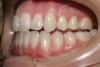 (7.) Pretreatment retracted close-up view of two defective 3-unit fixed partial dentures spanning teeth Nos. 6 through 8 and teeth Nos. 9 through 11.