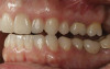 (8.) Retracted close-up view after removal of the defective fixed partial dentures.