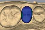 Figure 10 Occlusal view of designed restoration. The blue-colored areas indicate 2-mm thickness of porcelain.