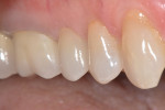 Figure 15 Finished restoration. Buccal view with enhanced esthetics.