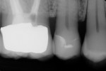Figure 16 Radiographic view of finished restoration verifying marginal adaptation and contour.