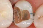 Figure 3 Pulpal floor and buccal cusp cracks were revealed after removal of the restoration. Occlusal mirror view.