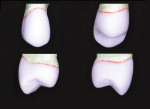 Figure 13 Milled restoration margins and overall restoration contours were evaluated on a stone die. Buccal, lingual, mesial, and distal views.