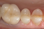 Figure 14 Occlusal view of finished restoration.