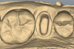 Figure 8 Digital scan of the prepared tooth and two adjacent teeth. Occlusal view.