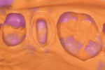 Figure 5 Vinyl polysiloxane (VPS) impression with well-defined margins.