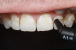 Figure 8 The dentin shade A1 IPS Empress Direct composite was placed.
