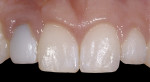 Figure 26  (Case 8) Note the improved position of the papilla after completion of the orthodontic eruption of No. 8.