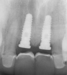 Figure 27  (Case 9) Radiograph following initial implant placement.