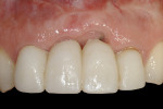 Figure 28  (Case 9) The patient presented with a tooth-supported provisional from Nos. 7 through 10. His concern was that the esthetics had been significantly compromised since the implants had been placed.
