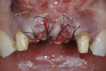 Figure 30  (Case 9) Pediculated connective tissue ridge augmentation was performed in the No. 8 and No. 9 sites (surgery by Dr. David Mathews, Tacoma, WA).