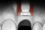 Figure 3  The bone zone is defined as the tissue apical to the implant-abutment interface. Contour change in this zone due to ridge collapse can lead to tissue discoloration below the head of the implant due to shine-through of the implant body.