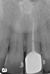 Figure 6  Periapical radiograph of tooth No. 9 showed a horizontal root fracture and distal open margin of the crown restoration.