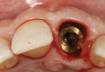Figure 10  After thorough socket debridement and verification of an intact buccal plate, a 5-mm diameter threaded implant was placed to the palatal aspect of the extraction socket, leaving a buccal residual gap distance of about 2 mm.