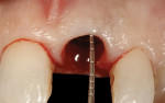 Figure 11  The implant-abutment interface was placed in a vertical spatial position coincident with the mid-facial crest of bone equivalent to the normal dentogingival complex.