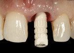 Figure 12  A screw-retained provisional abutment made of PEEK material was used; this provides strength and esthetics for an anterior implant restoration.
