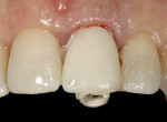 Figure 13  The prefabricated “egg shell” provisional restoration was filled with autopolymerizing acrylic resin and relined over the PEEK implant abutment.