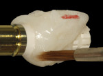 Figure 14  The secured provisional restoration can be placed onto an implant laboratory analog, and the contact areas clearly identified with a red wax pencil instead of graphite, which can discolor the acrylic resin if inadvertently incorporated. Ac