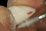 Figure 15  Definitive shaping/contouring of the provisional restoration performed with flame-shaped lab diamonds.