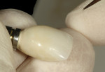 Figure 16  The final “supportive” contour of the provisional restoration was verified intraorally and then polished with flour of pumice with a wet ragwheel. Extrinsic acrylic colorants can be applied to the surface above the FGM to enhance and m