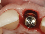 Figure 18  The provisional restoration was removed and a flat contoured healing abutment placed to allow access to the gap for bone graft placement/packing.